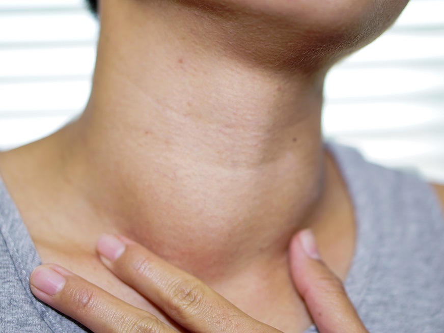 ¿Cuáles son los síntomas que alertan sobre un cáncer de tiroides?