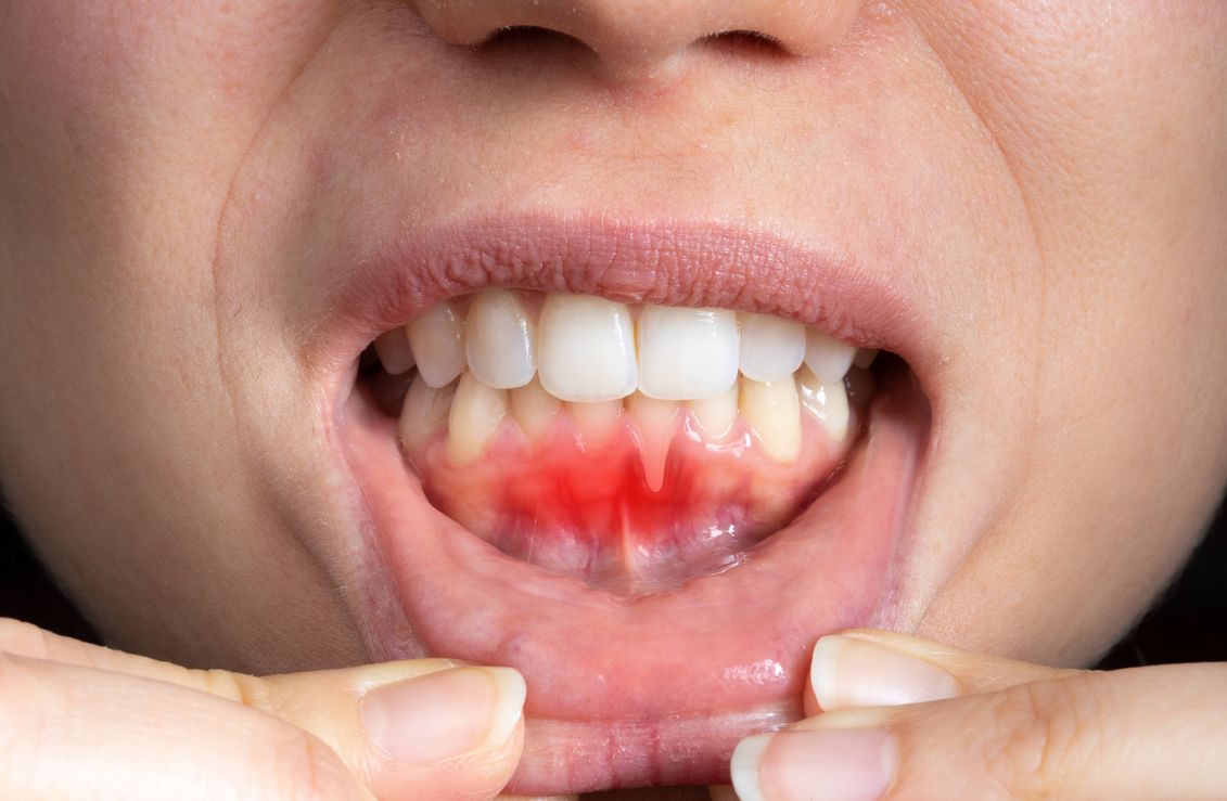 Enfermedades periodontales pueden agravar cuadros cardíacos, diabetes y embarazo
