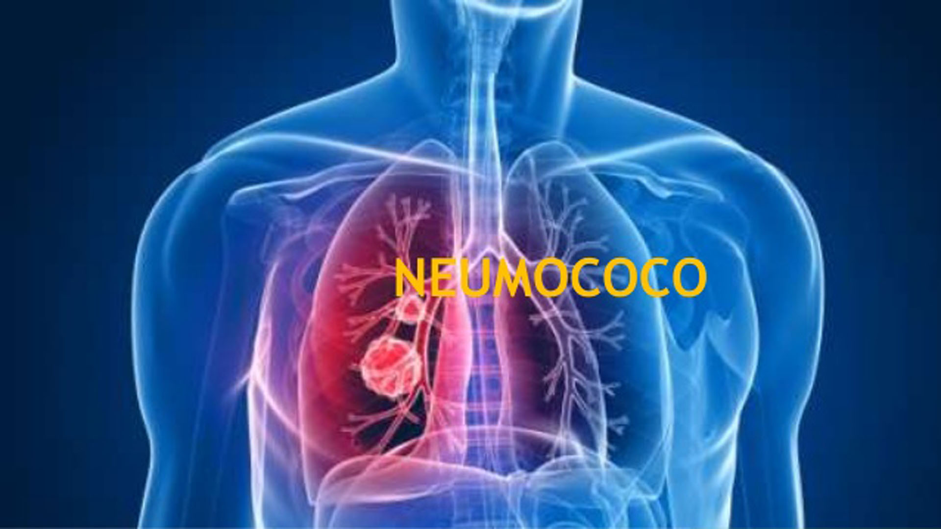 Neumococo: 3 enfermedades peligrosas causadas por esta bacteria