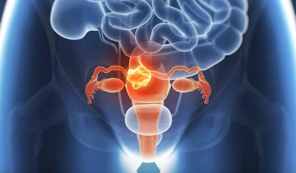 El 92% de los cánceres uterinos ocurren en el endometrio