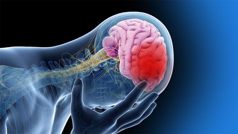 4 síntomas de un accidente cerebrovascular que no debemos ignorar