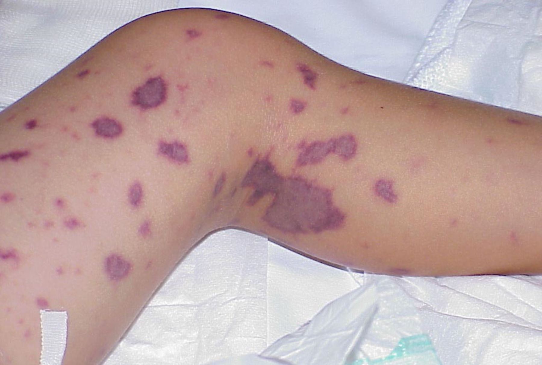 Meningitis por Meningococo: Enfermedad que ataca en menos de 24 horas ¿Cómo prevenirla?