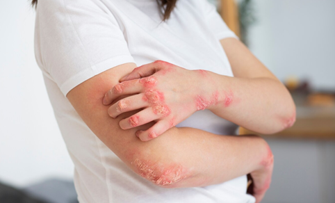 Sun Pharma revoluciona el tratamiento de la psoriasis en Perú con ILUMYA