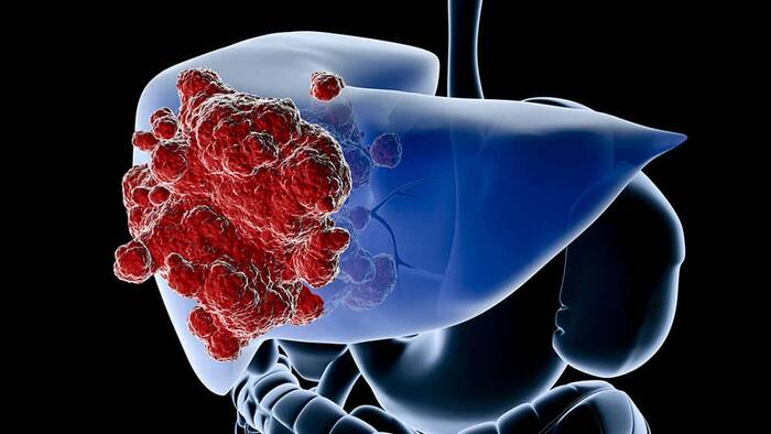 Cáncer de Hígado: Terapias podrían reducir el riesgo de muerte hasta en un 40%