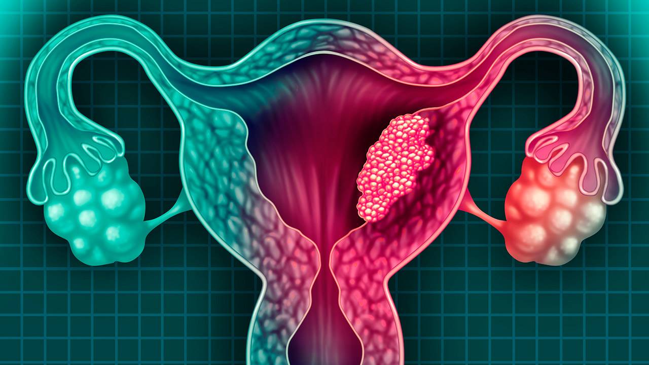 Advierten aumento de casos de cáncer de cuello uterino en el Perú