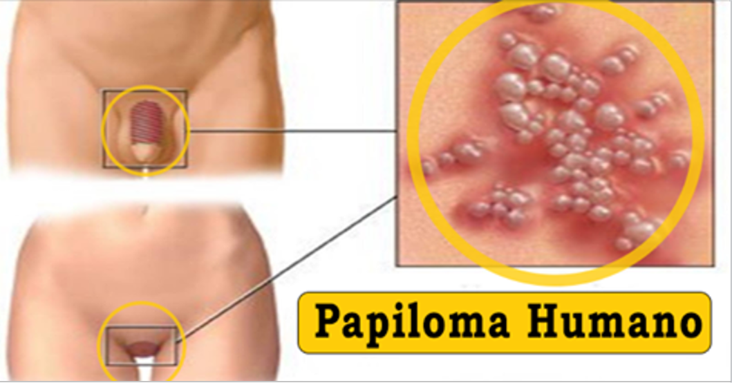 Lo que no sabía del virus del papiloma humano (VPH)