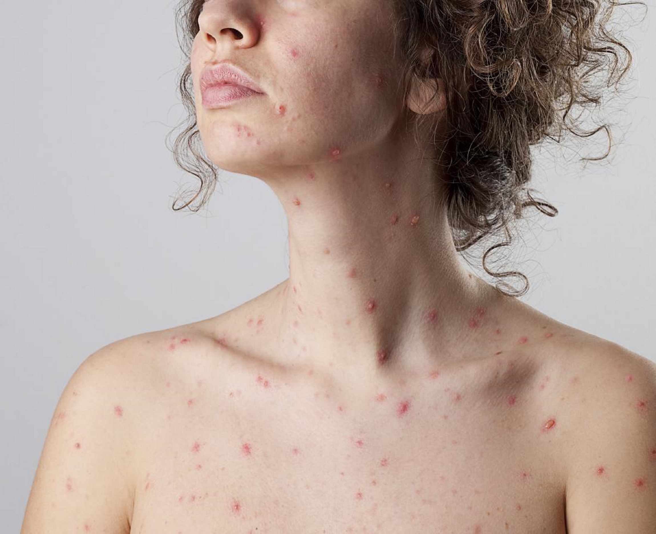 Conoce los peligros de la varicela en adolescentes y adultos