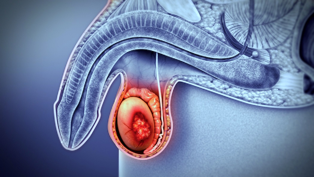 9 Mitos y verdades sobre el cáncer de próstata y testículo