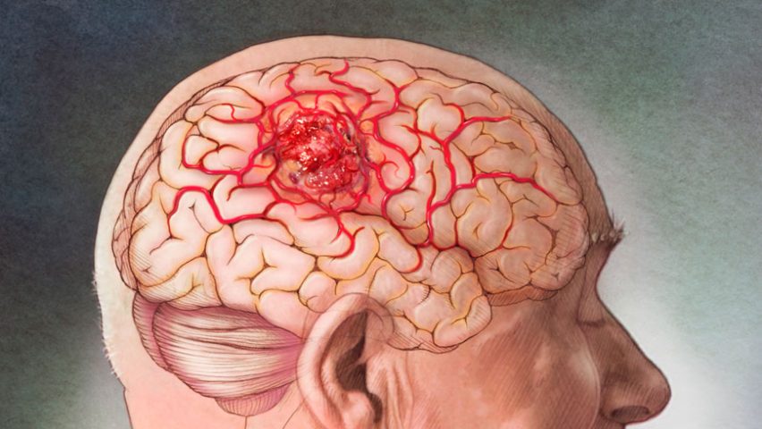 Cáncer de cerebro: ¿Es posible sobrevivir a este mal?