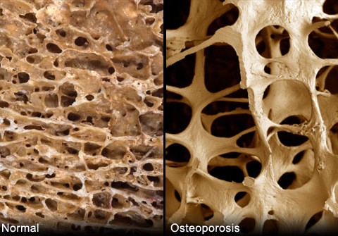 Mala alimentación genera el aumento de osteoporosis en las mujeres