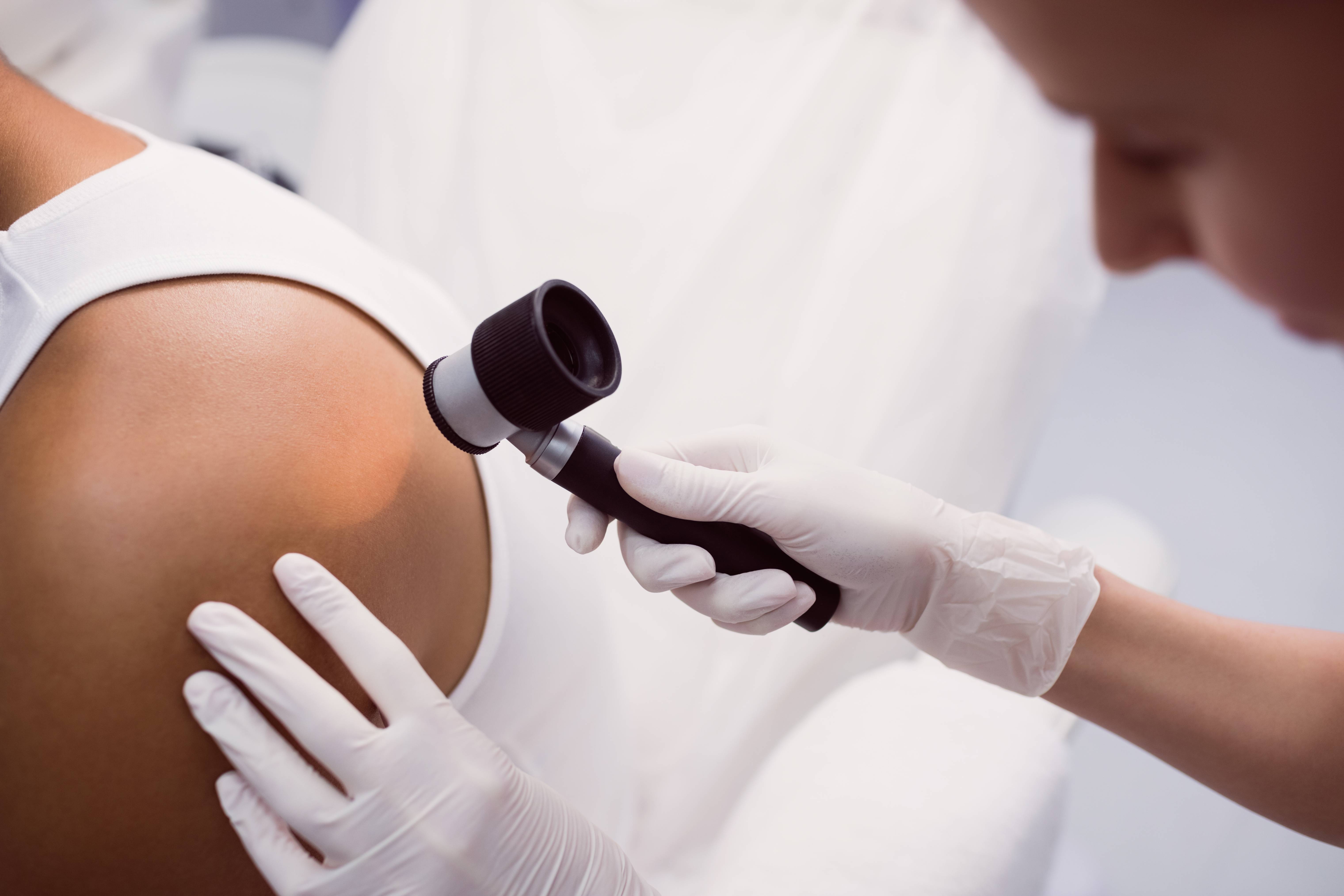 Seis formas de reducir el riesgo de padecer cáncer de piel