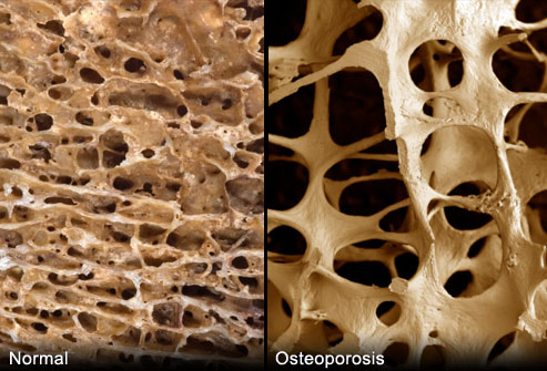 Mala alimentación genera el aumento de osteoporosis en las mujeres